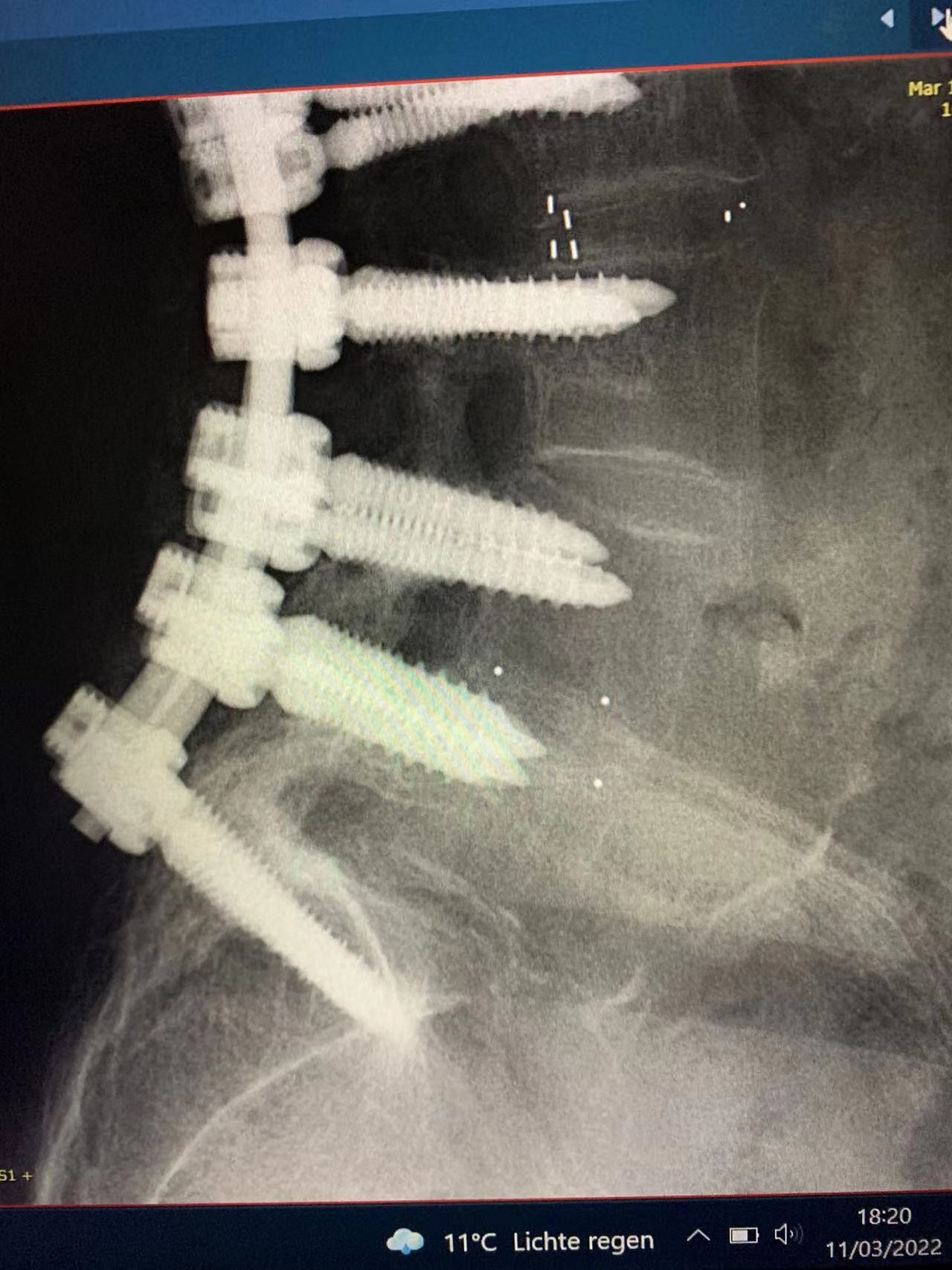 último caso de la compañía sobre Fijación interna quirúrgica espinal acertada